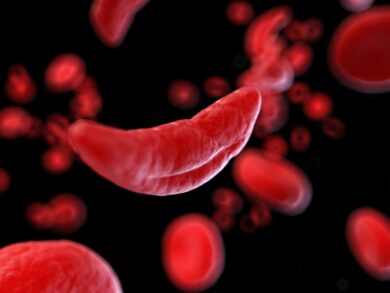 Anemia falciforme, arriva in Italia prima terapia contro crisi vaso-occlusive