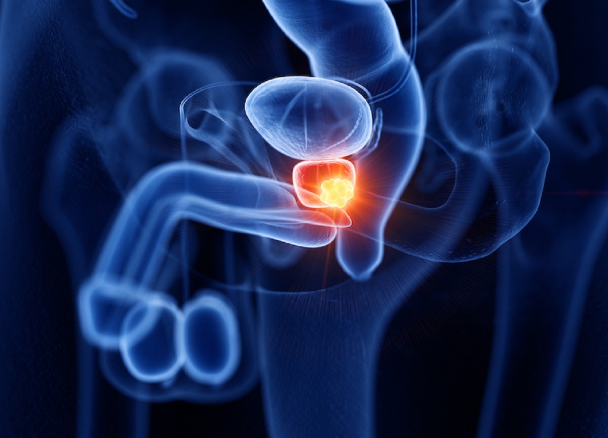 Tumore alla prostata, i cinque alimenti per contrastarlo: il nuovo studio Tumore alla prostata, i cinque alimenti per contrastarlo: il nuovo studio