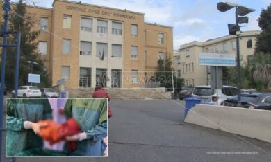 Asportato tumore di 7,5 kg in una giovane donna calabrese. È record