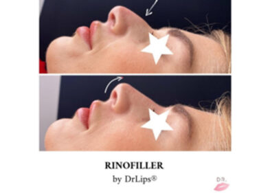 Rinofiller: correzioni al naso senza bisturi? ecco di cosa si tratta