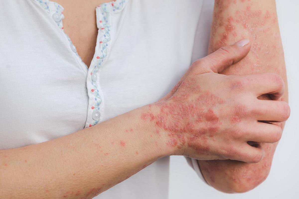 Psoriasi: le nuove terapie partono dai farmaci biologici Psoriasi: le nuove terapie partono dai farmaci biologici