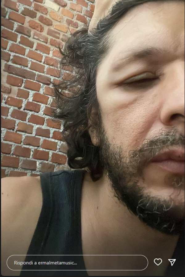 Ermal Meta: Ancora sconosciute le cause della malattia. Le foto choc