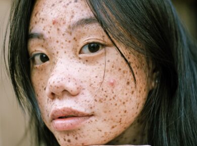 Mi stanno spuntando molti nei: è il caso di preoccuparsi?