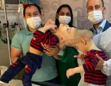 Separati i due gemelli siamesi brasiliani che condividevano i cervelli