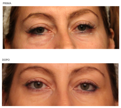 Come eliminare le borse sotto gli occhi? – Dvora Ancona