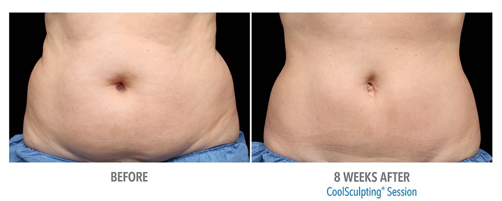 COOLSCULPTING: PER ELIMINARE LA PANCIA E SCOLPIRE GLI ADDOMINALI CON IL FREDDO