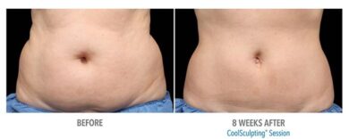 COOLSCULPTING: PER ELIMINARE LA PANCIA E SCOLPIRE GLI ADDOMINALI CON IL FREDDO