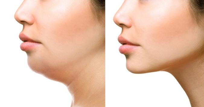 V – shape mania: tre tecnologie per un ovale perfetto – Dvora Ancona V – shape mania: tre tecnologie per un ovale perfetto – Dvora Ancona