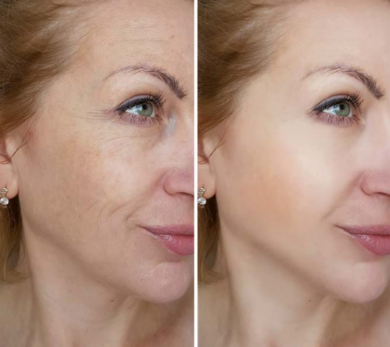 TURBO LASER PER RINGIOVANIRE IL VISO – DVORA ANCONA