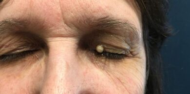 Cisti sebacea : cos’è e come trattarla  –  Dvora Ancona