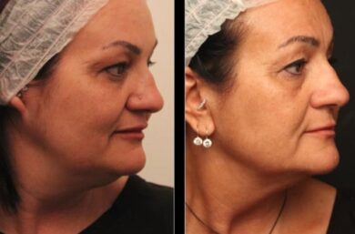 VIA IL DOPPIO MENTO CON LA RADIOFREQUENZA COREANA – DVORA ANCONA