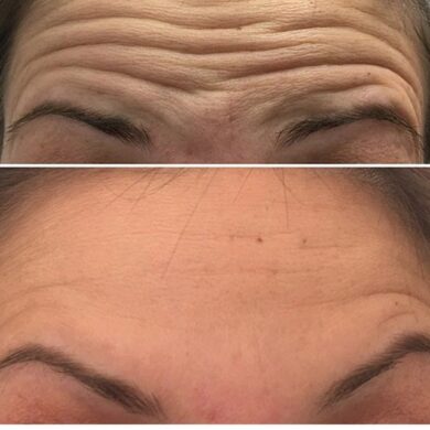 NEWS: RADIOFREQUENZA MONOPOLARE – L’ALTERNATIVA AL BOTULINO – DVORA ANCONA