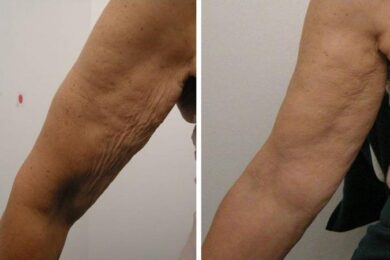 Nuova tecnologia per contrastare le lassità cutanee – Dvora Ancona