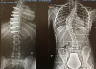 Quali sono le principali differenze tra scoliosi e cifosi?
