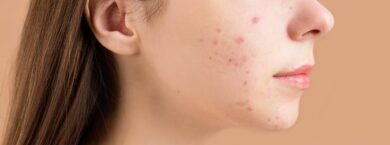 ACNES – NUOVA TECNOLOGIA COREANA PER ELIMINARE L’ACNE TARDIVA – DVORA ANCONA
