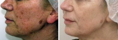 Via le macchie cutanee – Dvora Ancona