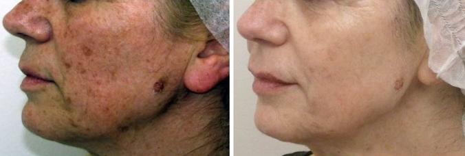 Via le macchie cutanee – Dvora Ancona Via le macchie cutanee – Dvora Ancona