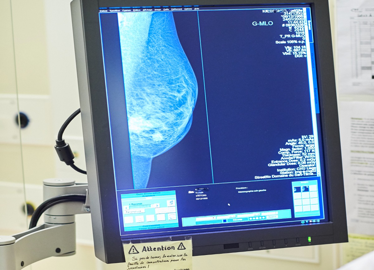 Cancro al seno, svolta: ecco come prevenire la recidiva che causa la morte Cancro al seno, svolta: ecco come prevenire la recidiva che causa la morte