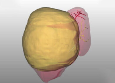 Miracolo al Bambin Gesù: rimosso un tumore di 2 kg da una bimba di 10 mesi