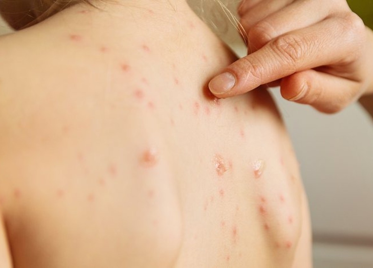 La minaccia di una nuova epidemia, paura per il virus: ecco quale La minaccia di una nuova epidemia, paura per il virus: ecco quale