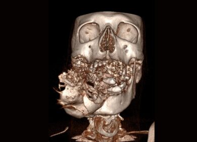 Gli ricostruiscono la mandibola devastata dal tumore con il suo stesso perone