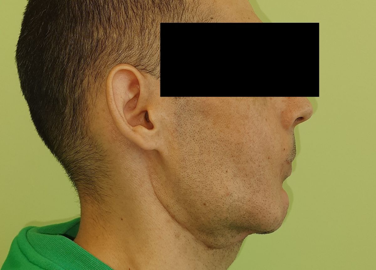 Gli ricostruiscono la mandibola devastata dal tumore con il suo stesso perone