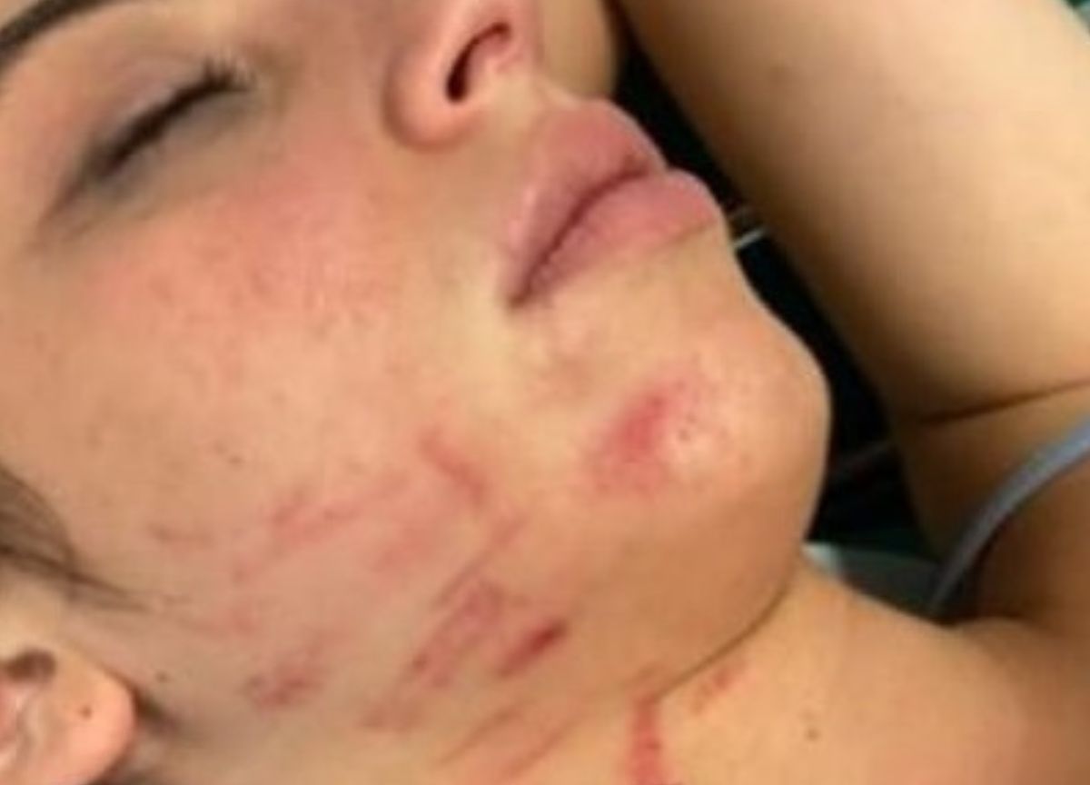 Milano, 21enne aggredita per rubarle la borsetta: “Ho ancora gli incubi”. FOTO Milano, 21enne aggredita per rubarle la borsetta: “Ho ancora gli incubi”. FOTO