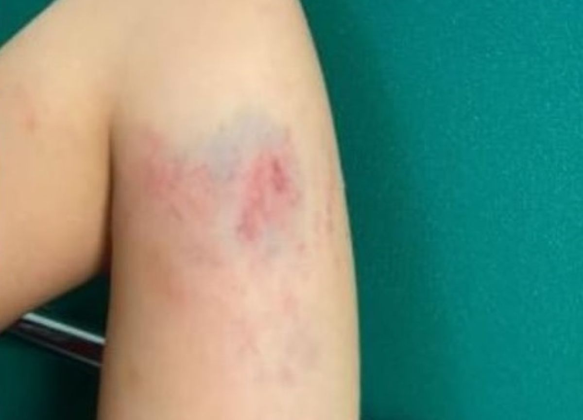 Milano, 21enne aggredita per rubarle la borsetta: “Ho ancora gli incubi”. FOTO Milano, 21enne aggredita per rubarle la borsetta: “Ho ancora gli incubi”. FOTO
