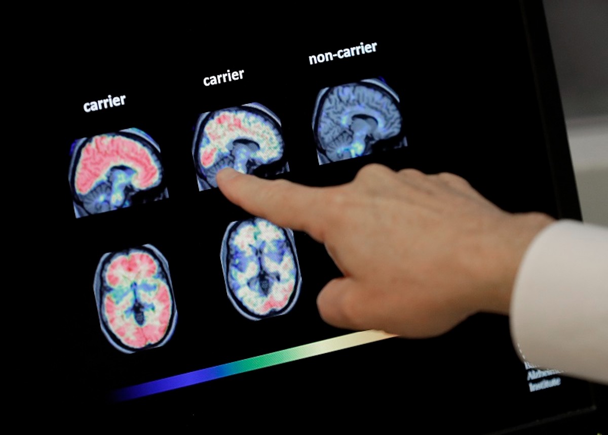 Alzheimer, ricerca rivoluzionaria. Si può scoprire la malattia 18 anni prima Alzheimer, ricerca rivoluzionaria. Si può scoprire la malattia 18 anni prima