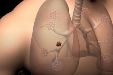 Tumore ai polmoni, c’è la svolta: un farmaco capace di fermare la malattia