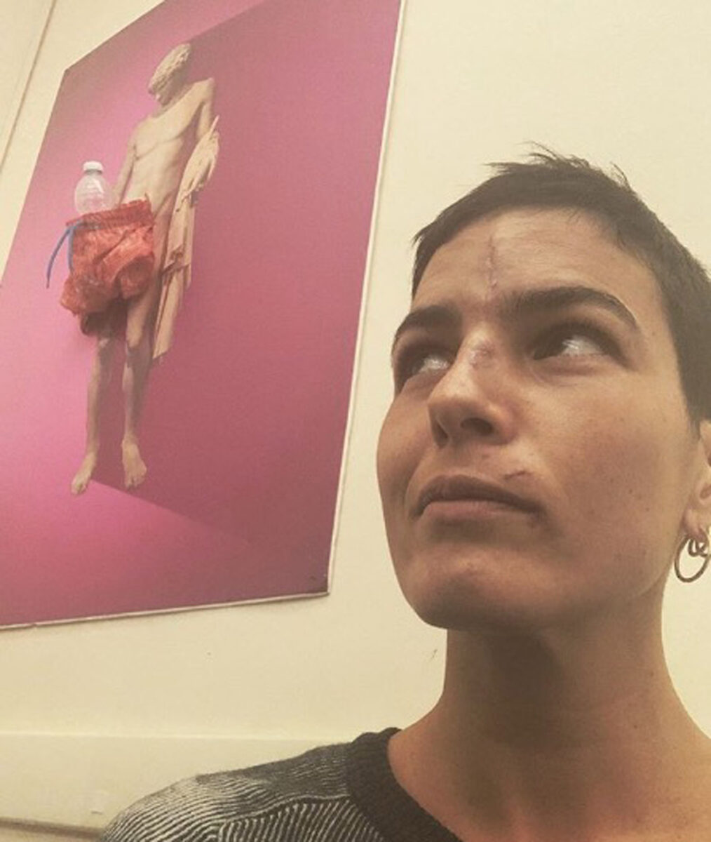 Chiara Masciotta, ex miss Italia rimasta senza naso che si è rifatta una vita