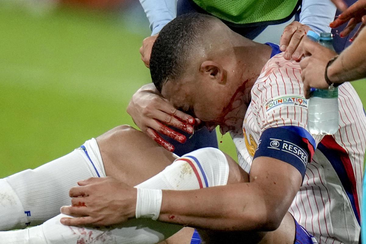 Mbappé naso rotto con l’Austria, ansia Francia a Euro 2024: come sta Kylian Mbappé naso rotto con l’Austria, ansia Francia a Euro 2024: come sta Kylian