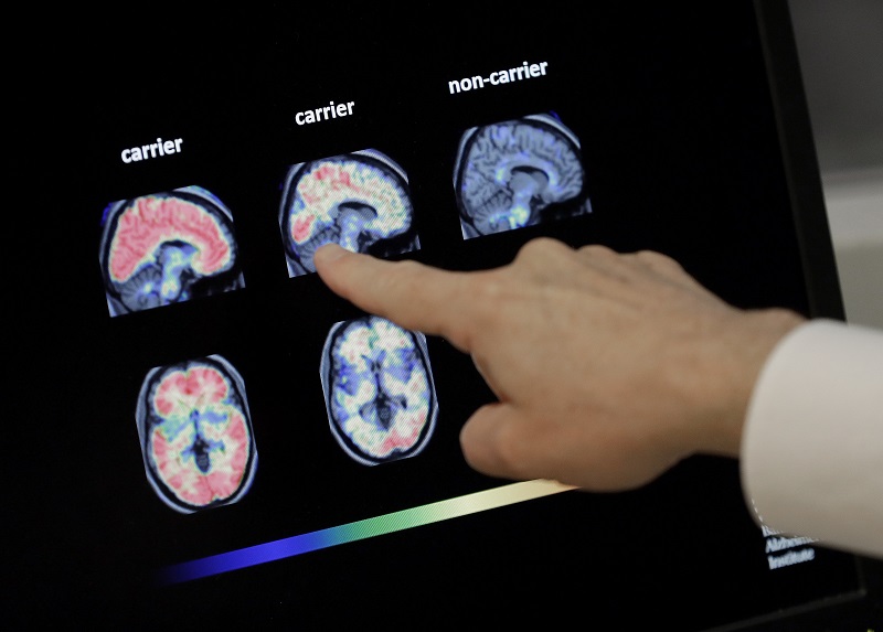 Alzheimer, una possibile cura grazie alla scoperta di un gruppo di molecole Alzheimer, una possibile cura grazie alla scoperta di un gruppo di molecole