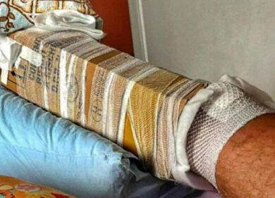 Frattura bloccata in ospedale con un cartone. Castelli: “Questa è la sanità italiana. Ma il Governo pensa a un incontro di boxe”