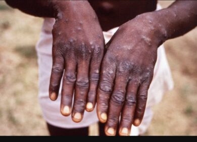 In Svezia il primo caso fuori dall’Africa, il vaiolo delle scimmie arriva in Europa. Nuova pandemia in arrivo?