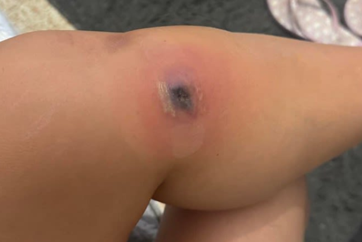 Giovane morsa da un ragno violino nella doccia: ha rischiato la necrosi alla gamba Giovane morsa da un ragno violino nella doccia: ha rischiato la necrosi alla gamba