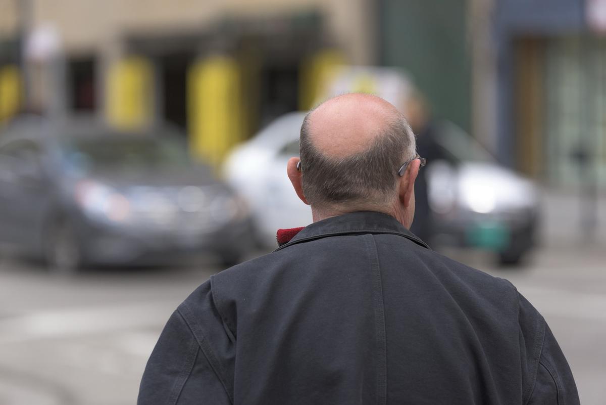 Addio per sempre alle calvizie: i capelli ricrescono grazie al microRNA. Ecco di che cosa si tratta Addio per sempre alle calvizie: i capelli ricrescono grazie al microRNA. Ecco di che cosa si tratta
