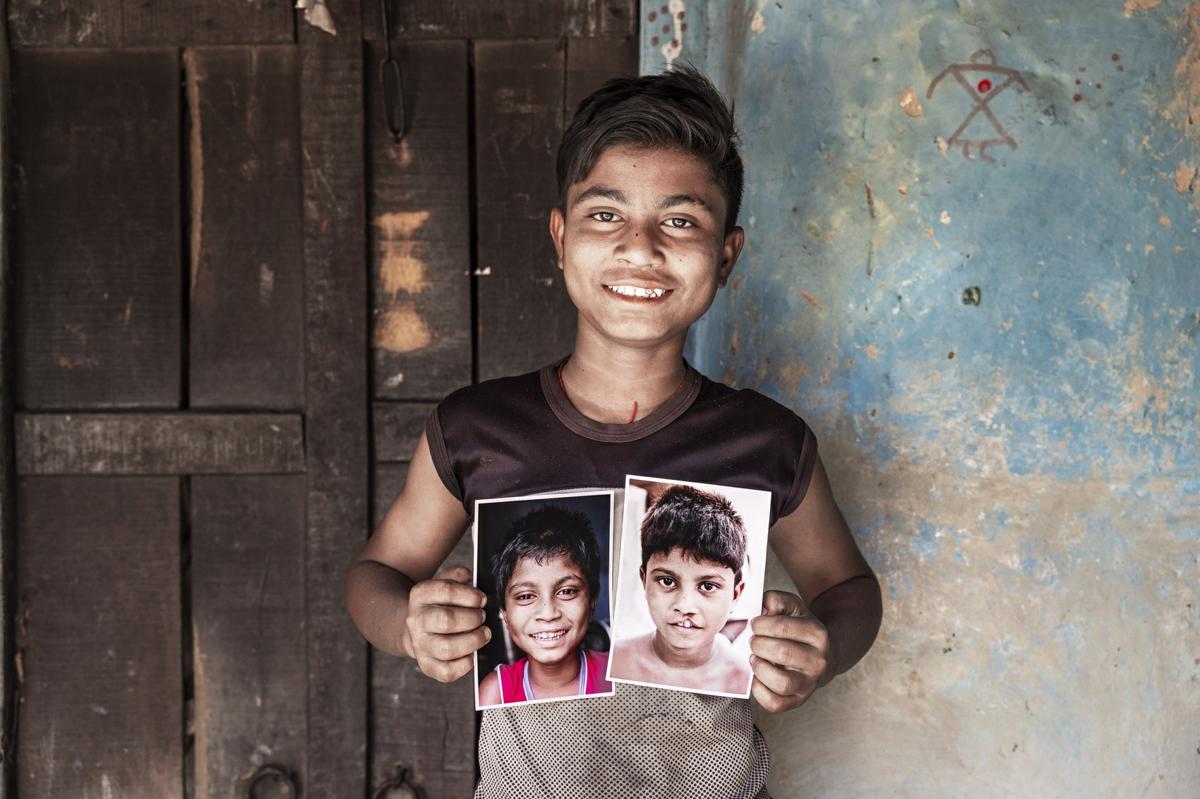 “Sorrido perché”, la campagna per donare cure a chi nasce con malformazioni del volto “Sorrido perché”, la campagna per donare cure a chi nasce con malformazioni del volto