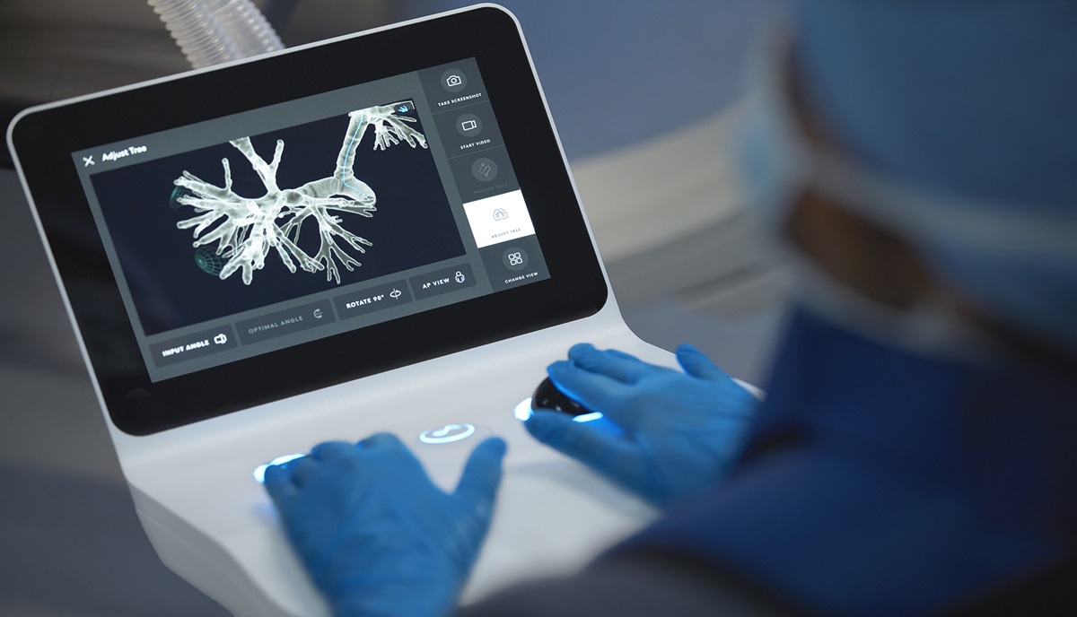 ION: Innovazione tecnologica per la diagnosi precoce del tumore al polmone ION: Innovazione tecnologica per la diagnosi precoce del tumore al polmone