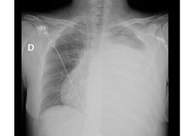 Tumore grande come un cocomero asportato a Roma ad una donna