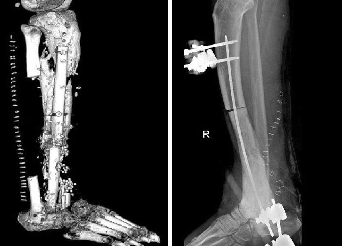Mix di batteri gli divora la “carne”, operazione al Gemelli gli salva gamba e piede Mix di batteri gli divora la “carne”, operazione al Gemelli gli salva gamba e piede