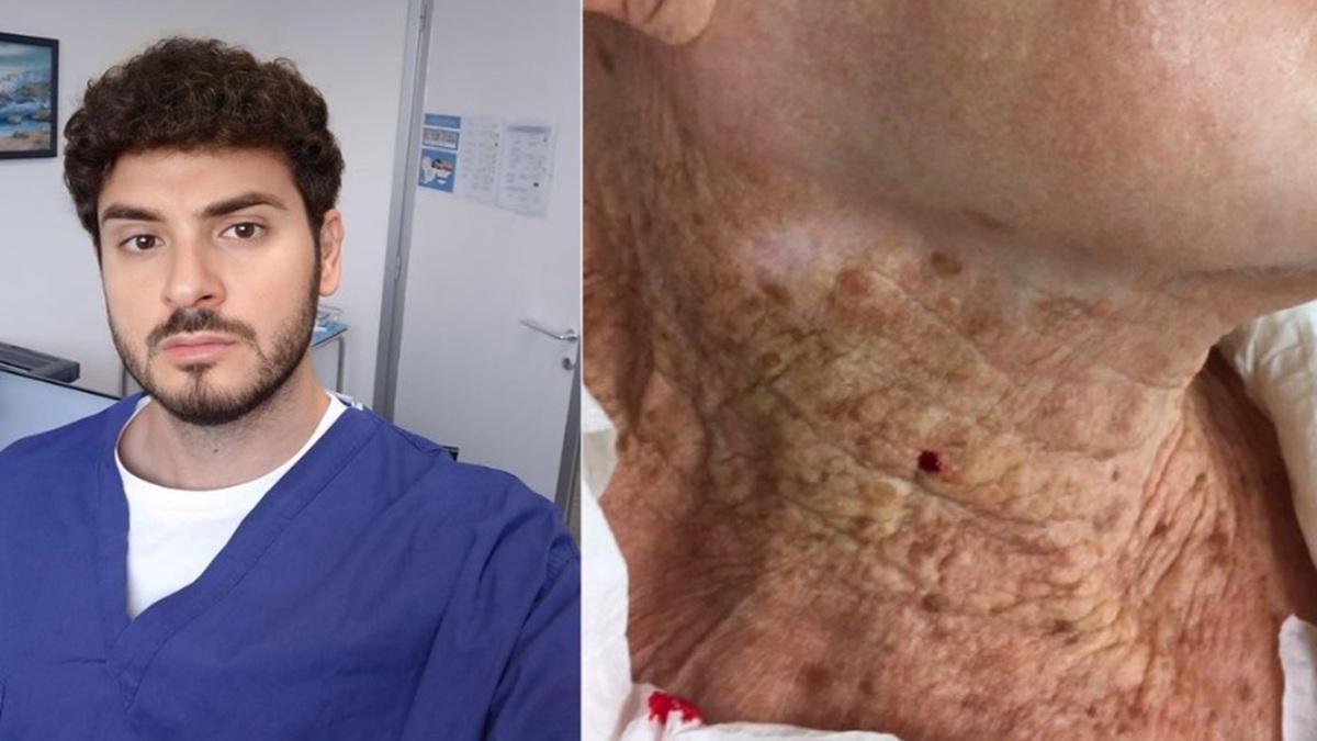 “Anni di sole senza protezione? Prima o poi la pelle presenta il conto”: il chirurgo del San Raffaele sui tumori cutanei “Anni di sole senza protezione? Prima o poi la pelle presenta il conto”: il chirurgo del San Raffaele sui tumori cutanei